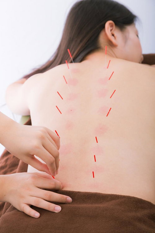 背骨に沿って行う鍼治療による疲労回復とストレス緩和