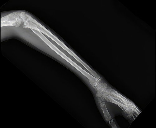 【骨注意】小学生6年生の女の子の左腕のレントゲン撮影