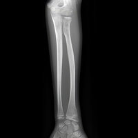 左腕の橈骨と尺骨が映るレントゲンの写真