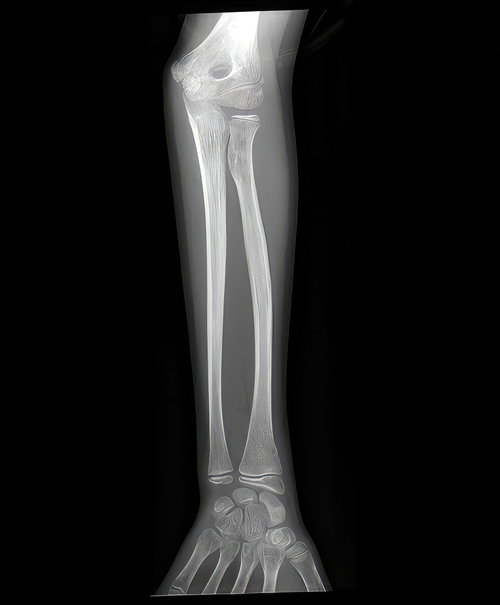 【骨注意】左腕の橈骨と尺骨が映るレントゲン