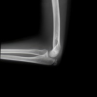 肘関節のレントゲン写真：橈骨・尺骨の骨構造の写真